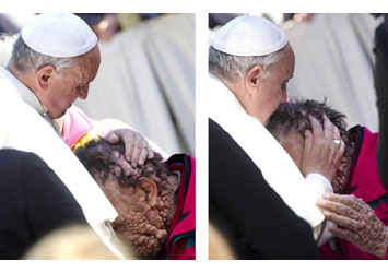 Pope Francis Blessing a Disfigured man 